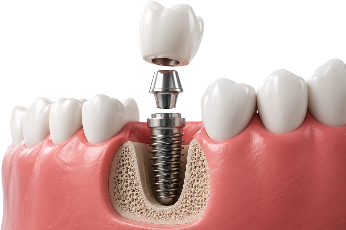 Exploded dental implant model positioned between natural teeth